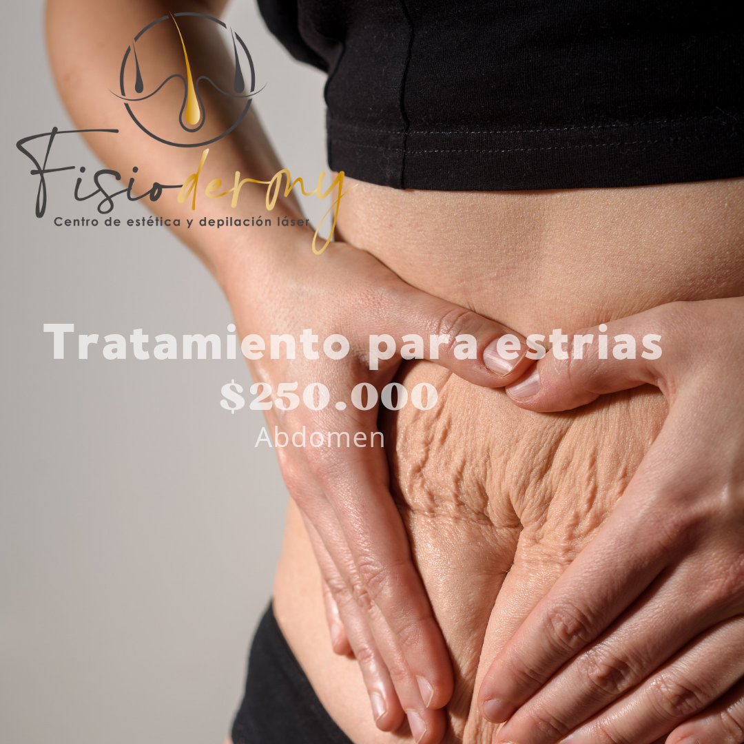 Estrias galvanopuntura