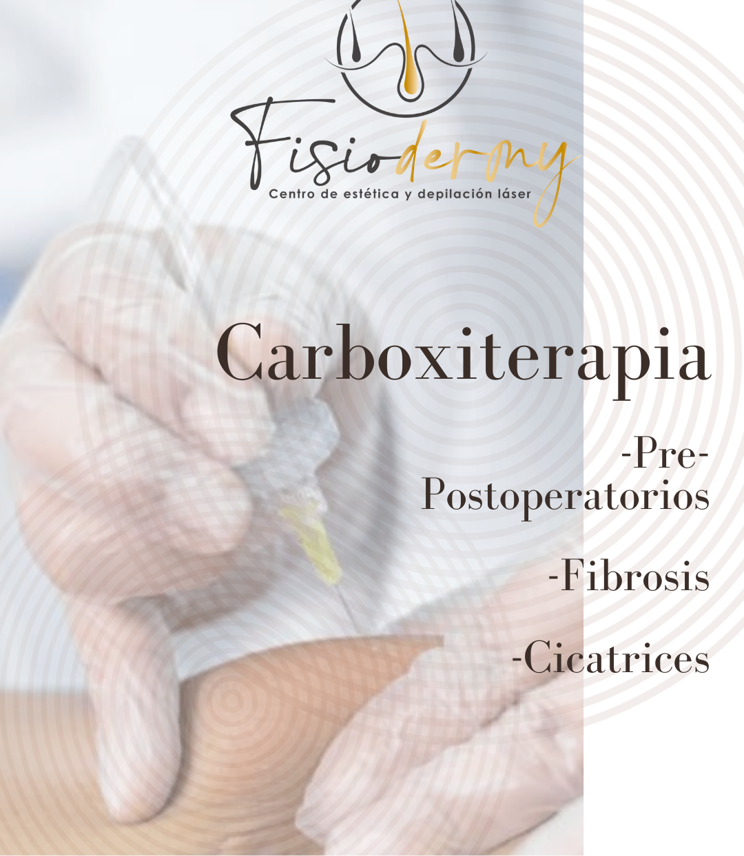 Carboxiterapia Ares High Volt Pre-postoperatorio 8 sesiones