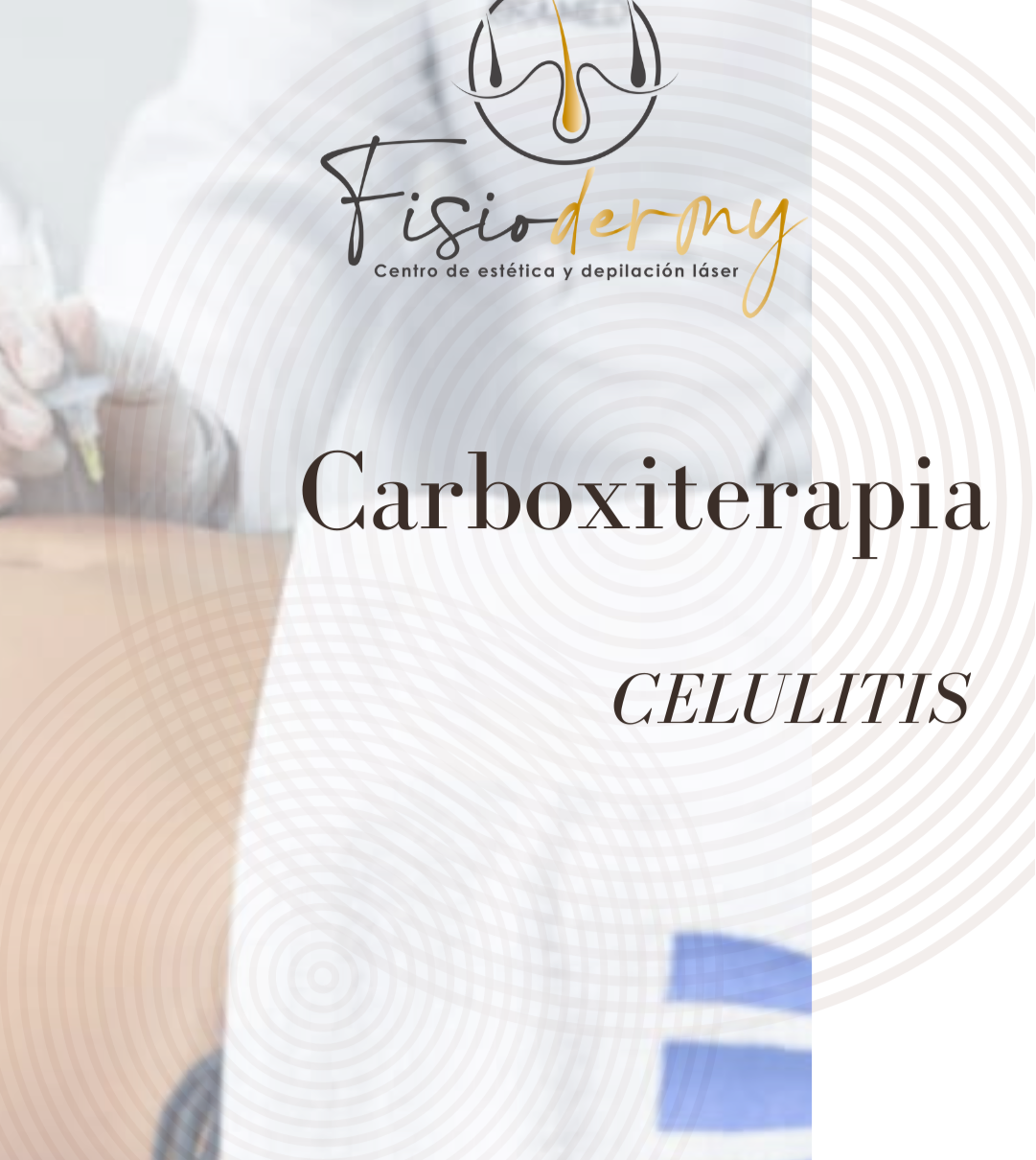 Carboxiterapia Celulitis