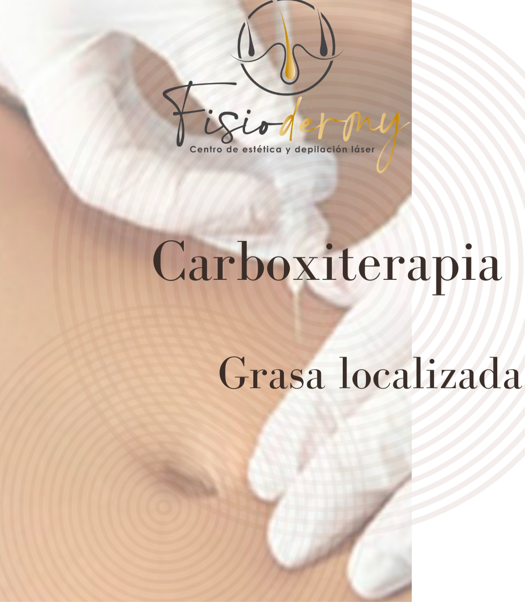 Carboxiterapia Grasa localizada Ares High Volt más radiofrecuencia