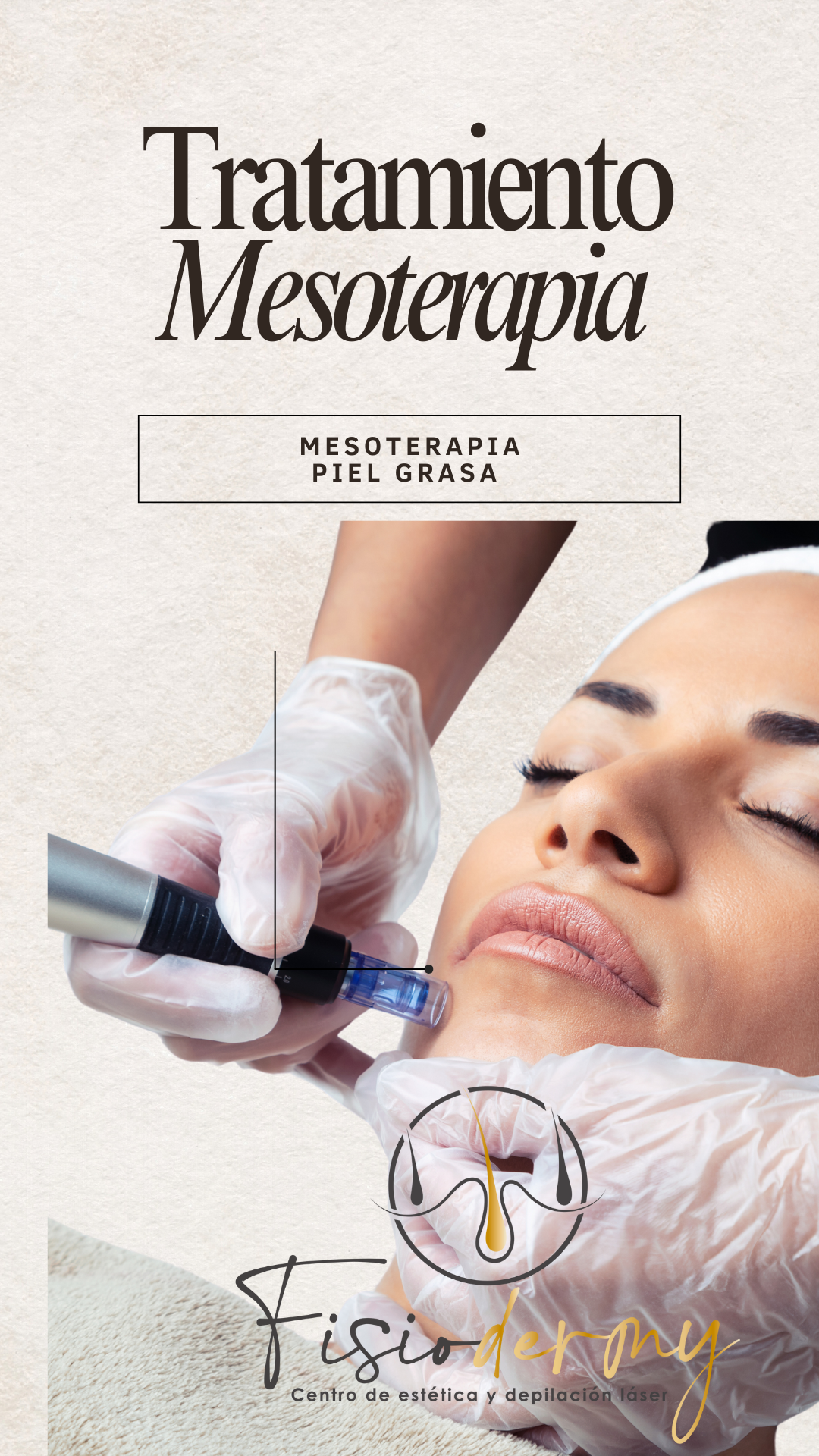 Mesoterapia piel grasa F-ACN 1 sesión