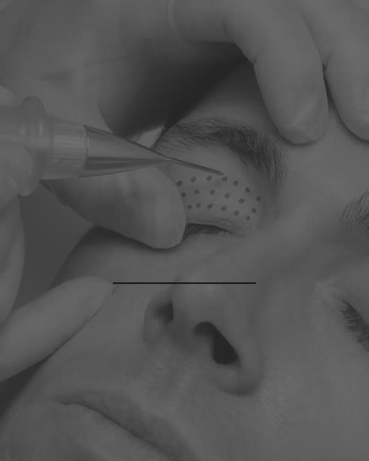 PLASMED FIBROBLAST PÁRPADO Y OJERAS